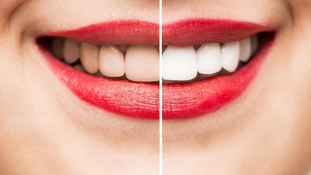 Smile Brighter with Crest Whitening Strips: A Game-Changing Oral Care Solution